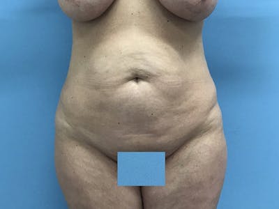 Tummy Tuck Gallery - Patient 120905468 - Image 1