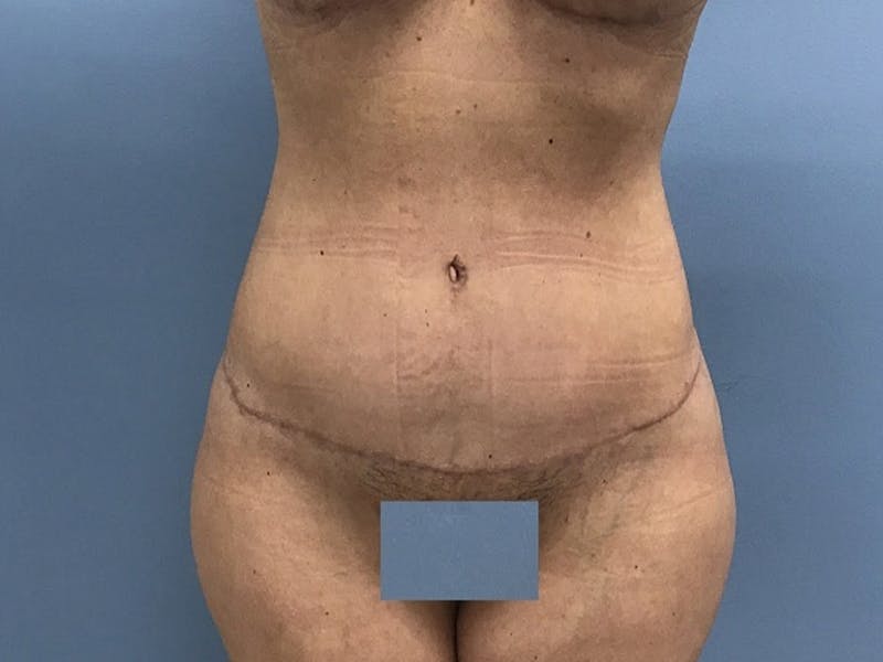 Tummy Tuck Before & After Gallery - Patient 120905468 - Image 2
