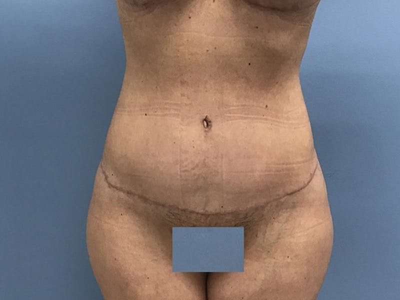 Tummy Tuck Gallery - Patient 120905468 - Image 2
