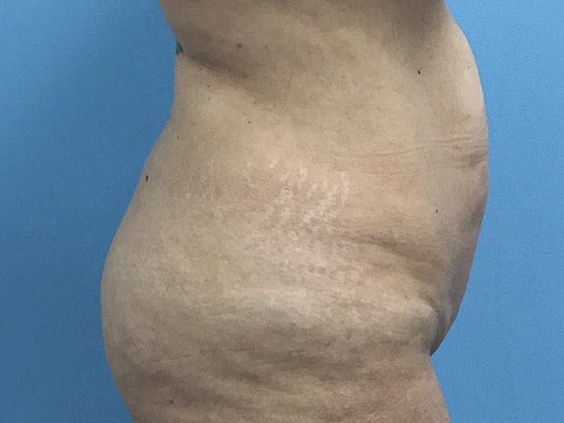 Tummy Tuck Before & After Gallery - Patient 120905468 - Image 3