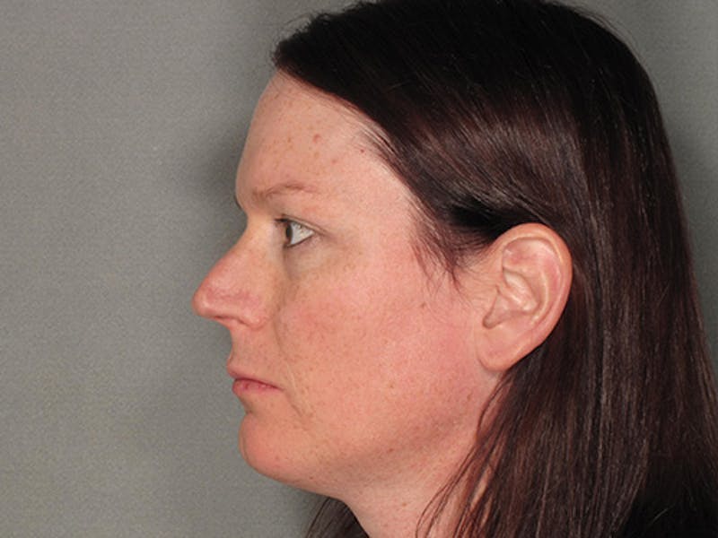 Rhinoplasty Before & After Gallery - Patient 120905461 - Image 3