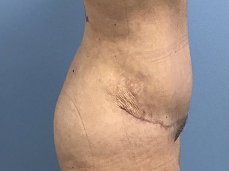 Tummy Tuck Before & After Gallery - Patient 120905468 - Image 4