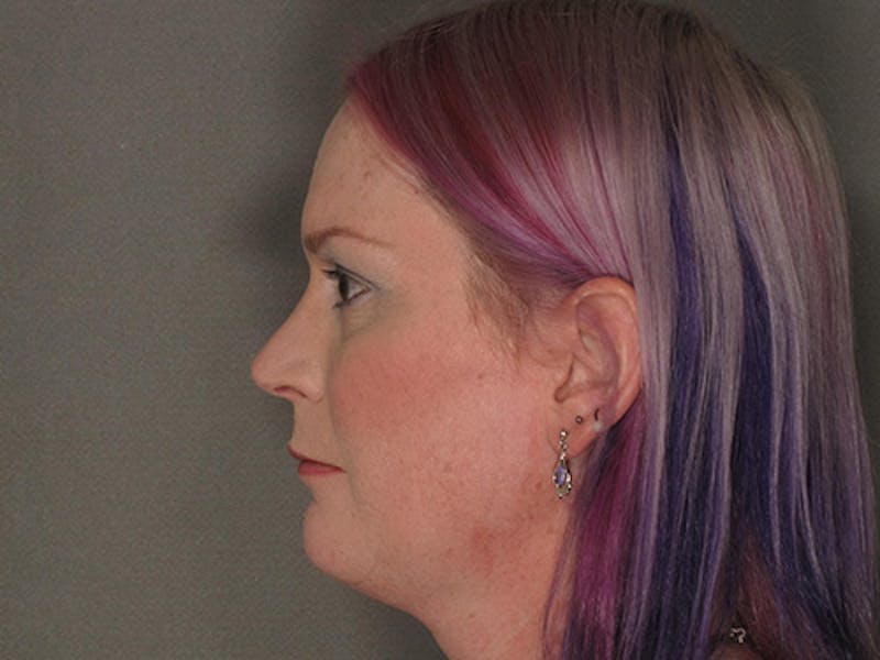 Rhinoplasty Before & After Gallery - Patient 120905461 - Image 4