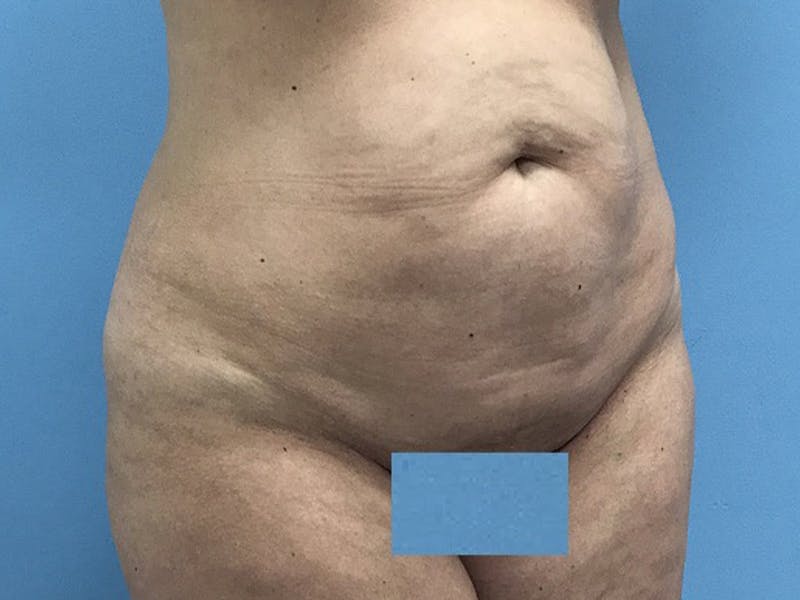 Tummy Tuck Before & After Gallery - Patient 120905468 - Image 5