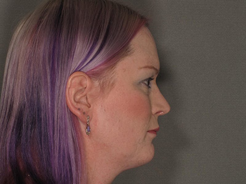 Rhinoplasty Before & After Gallery - Patient 120905461 - Image 6