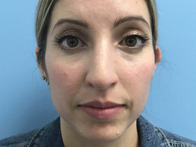 Rhinoplasty Before & After Gallery - Patient 120905471 - Image 1