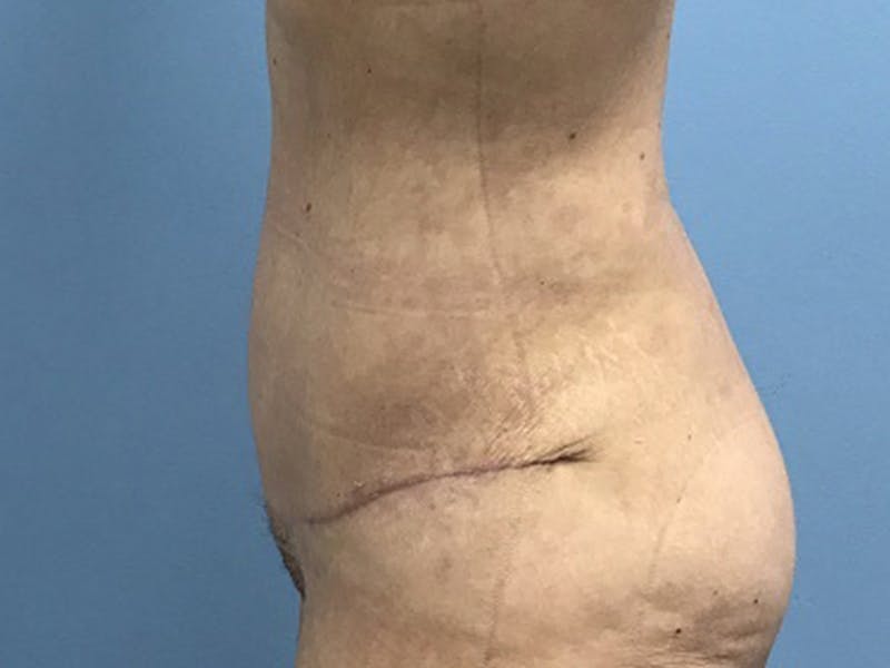 Tummy Tuck Before & After Gallery - Patient 120905468 - Image 8