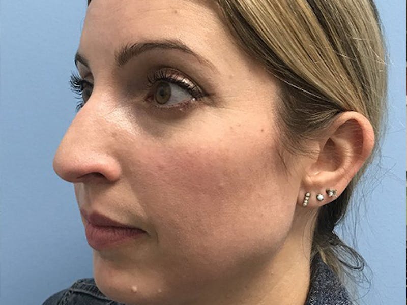 Rhinoplasty Before & After Gallery - Patient 120905471 - Image 3
