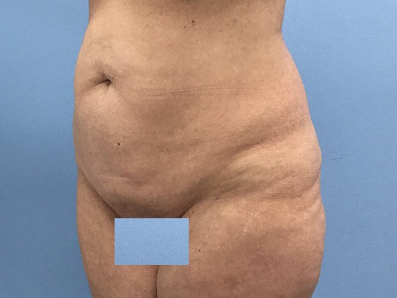 Tummy Tuck Before & After Gallery - Patient 120905468 - Image 9