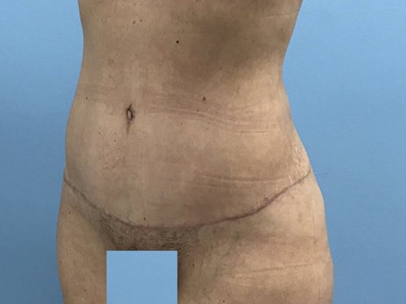 Tummy Tuck Before & After Gallery - Patient 120905468 - Image 10