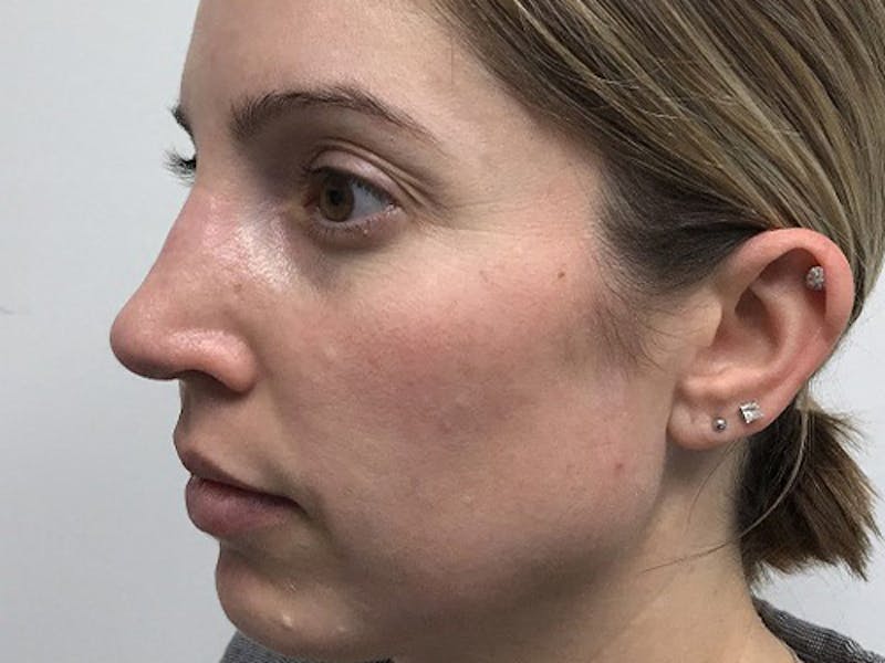 Rhinoplasty Before & After Gallery - Patient 120905471 - Image 4