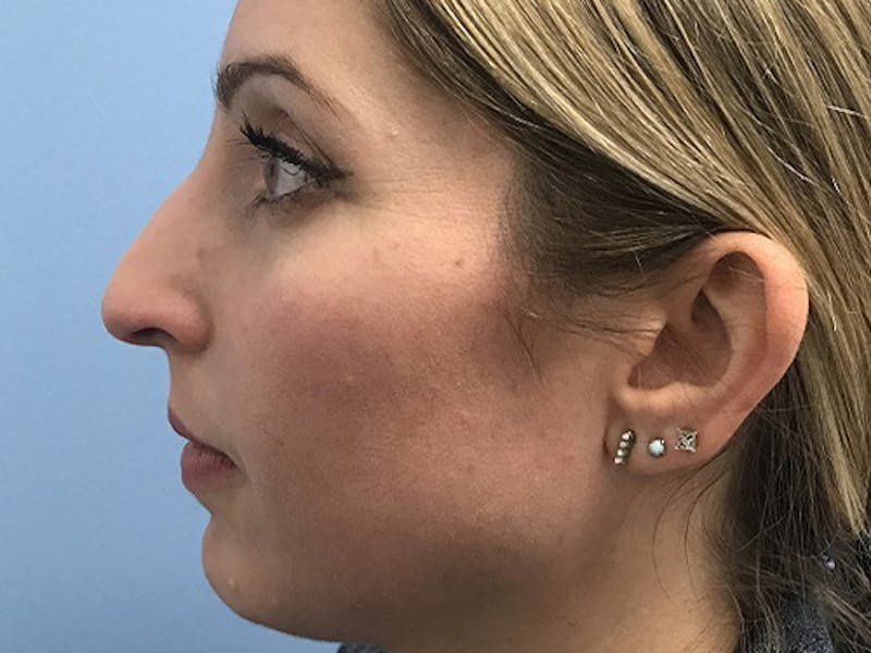Rhinoplasty Before & After Gallery - Patient 120905471 - Image 5