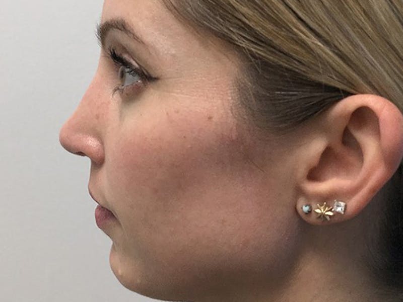 Rhinoplasty Before & After Gallery - Patient 120905471 - Image 6