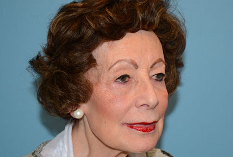 Blepharoplasty Before & After Gallery - Patient 120905493 - Image 3