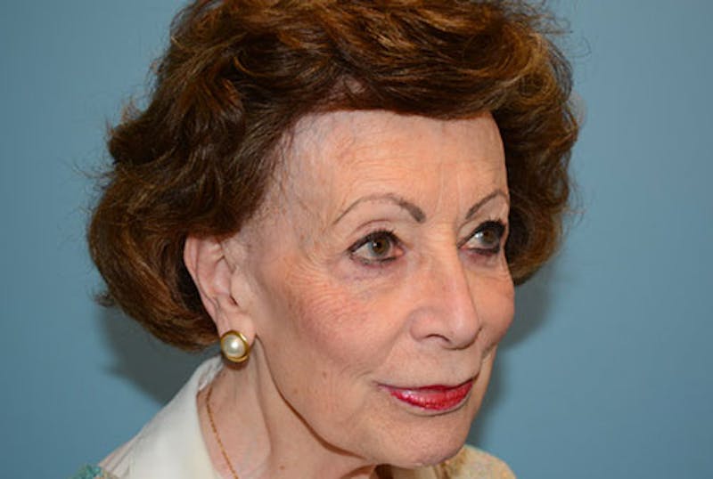 Blepharoplasty Before & After Gallery - Patient 120905493 - Image 4