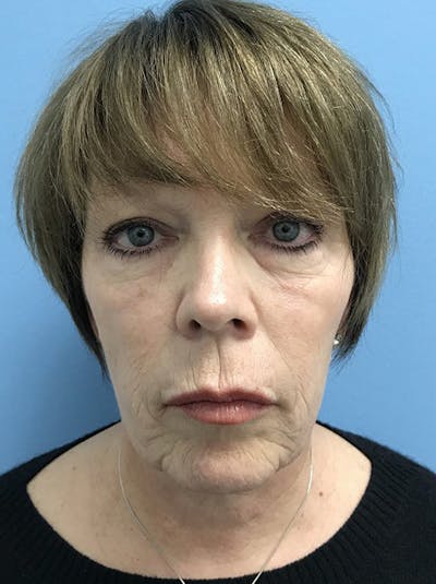 Blepharoplasty Before & After Gallery - Patient 120905523 - Image 1