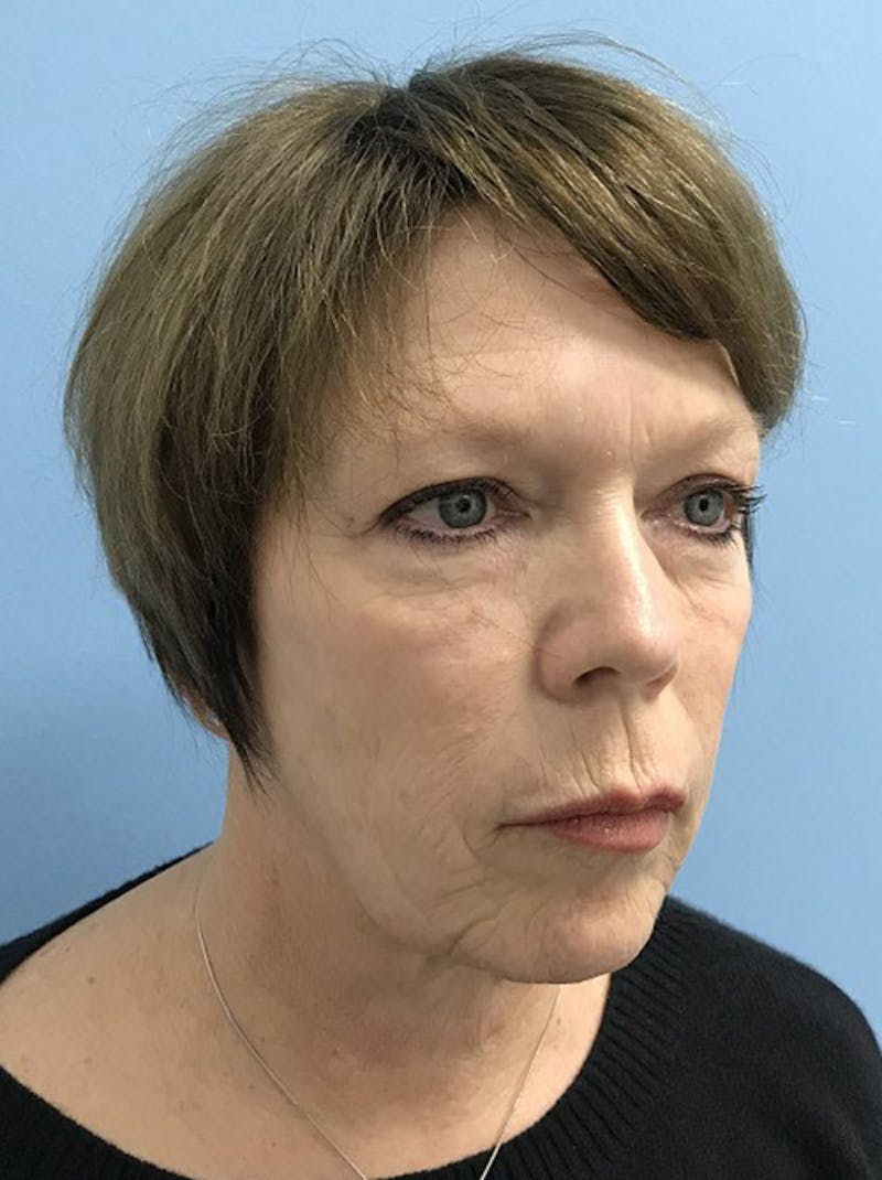 Blepharoplasty Before & After Gallery - Patient 120905523 - Image 3