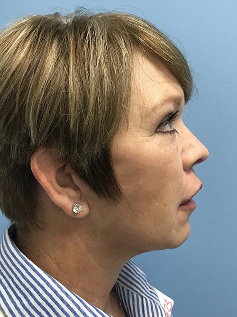 Blepharoplasty Before & After Gallery - Patient 120905523 - Image 6