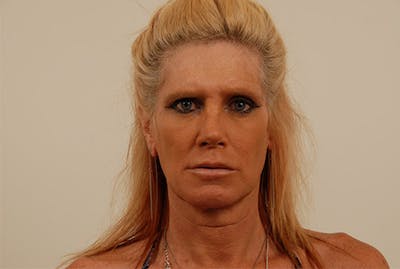 Facial Feminization Before & After Gallery - Patient 120905549 - Image 1