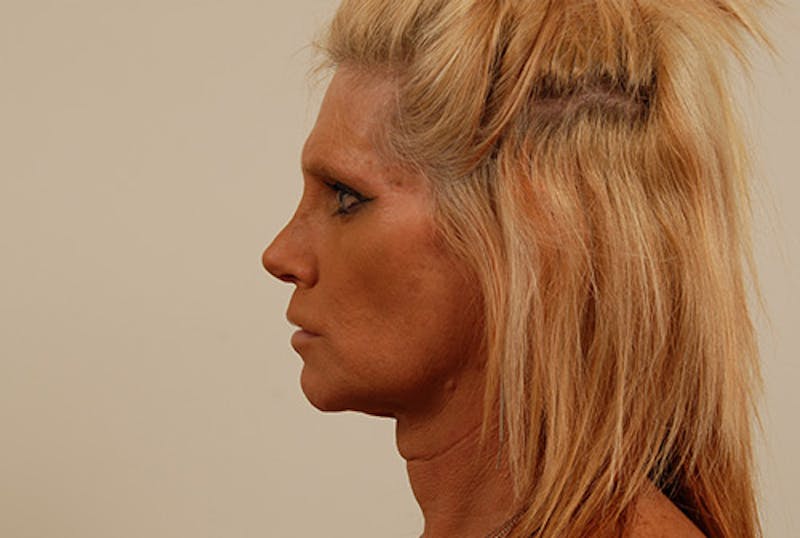 Facial Feminization Before & After Gallery - Patient 120905549 - Image 5