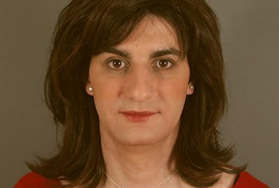 Facial Feminization Before & After Gallery - Patient 120905578 - Image 1