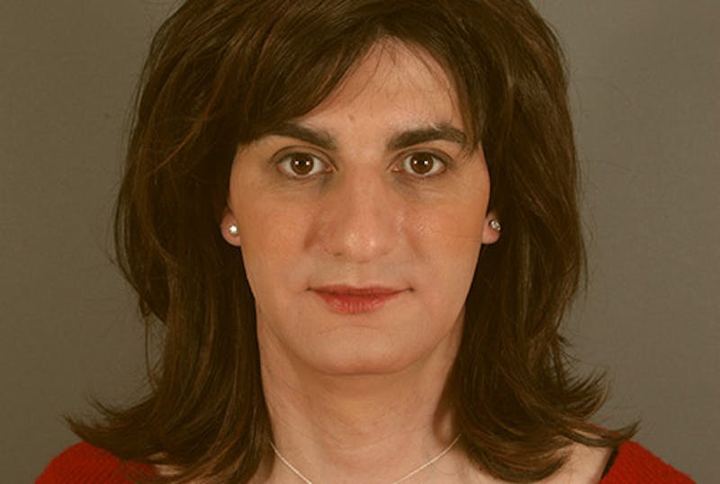 Facial Feminization Before & After Gallery - Patient 120905578 - Image 3