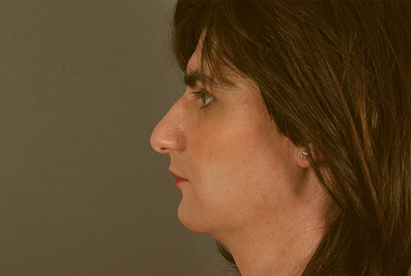 Facial Feminization Before & After Gallery - Patient 120905578 - Image 7