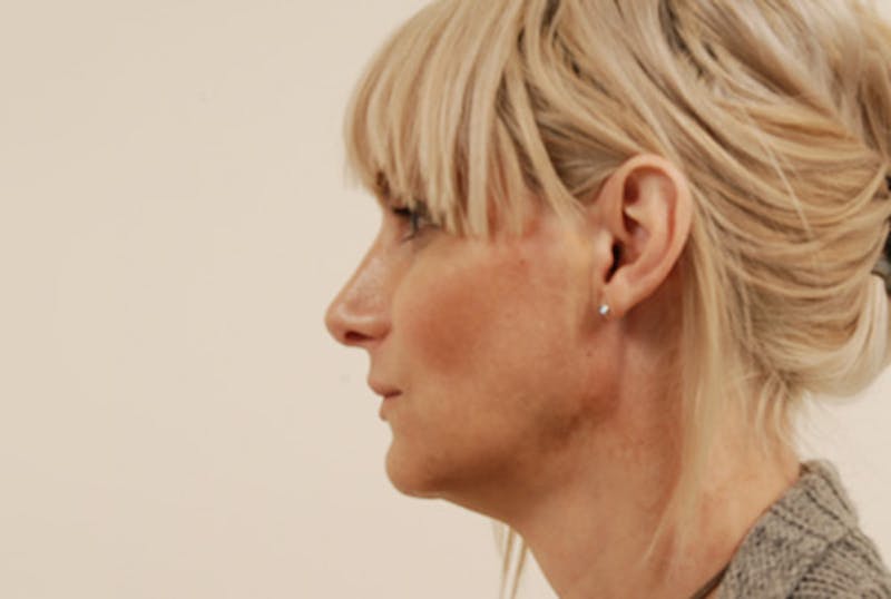 Facial Feminization Before & After Gallery - Patient 120905578 - Image 8