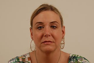 Facial Feminization Before & After Gallery - Patient 120905579 - Image 2