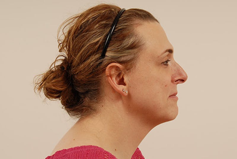 Facial Feminization Before & After Gallery - Patient 120905579 - Image 3