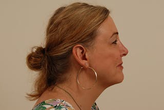 Facial Feminization Before & After Gallery - Patient 120905579 - Image 4