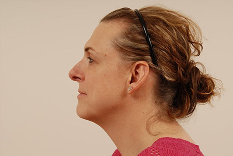Facial Feminization Before & After Gallery - Patient 120905579 - Image 5