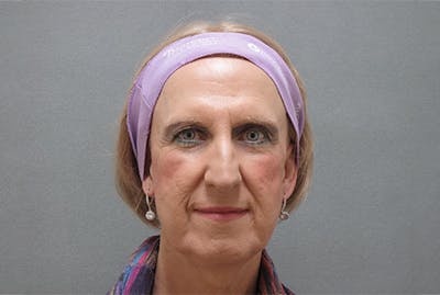 Facial Feminization Before & After Gallery - Patient 120905580 - Image 1