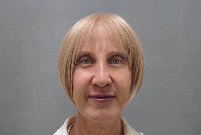 Facial Feminization Before & After Gallery - Patient 120905580 - Image 2