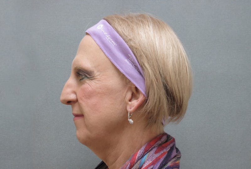 Facial Feminization Before & After Gallery - Patient 120905580 - Image 3