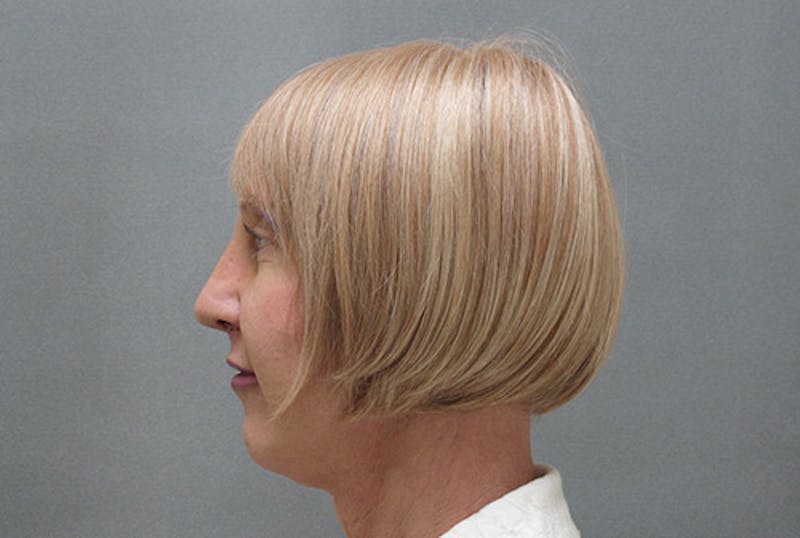 Facial Feminization Before & After Gallery - Patient 120905580 - Image 4