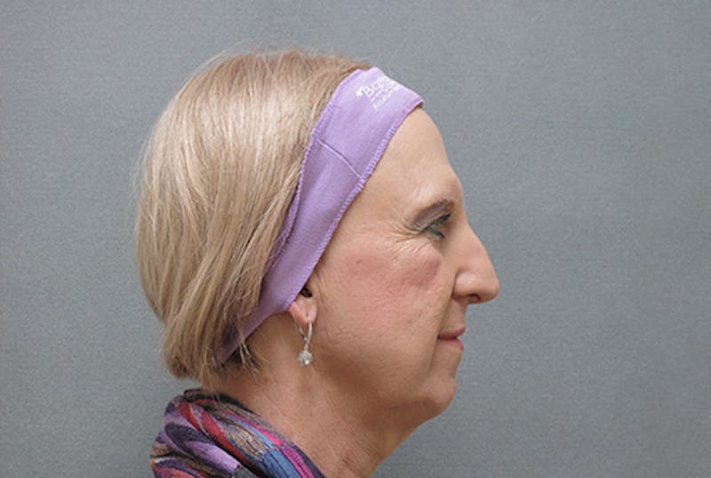 Facial Feminization Before & After Gallery - Patient 120905580 - Image 5