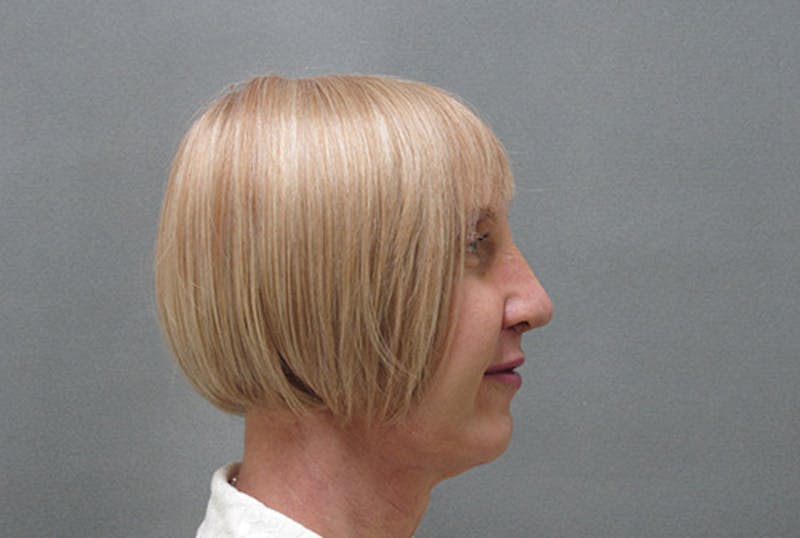 Facial Feminization Before & After Gallery - Patient 120905580 - Image 6