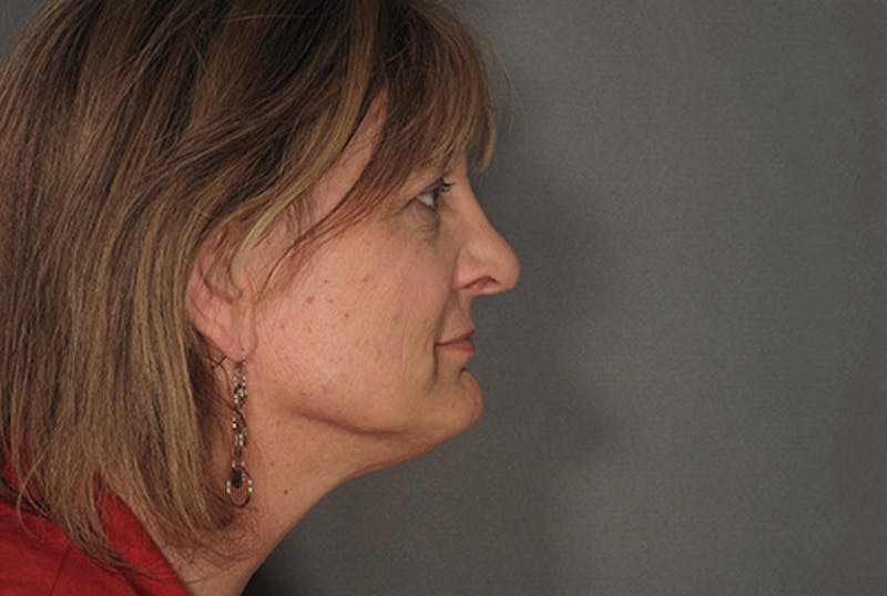 Facial Feminization Before & After Gallery - Patient 120905581 - Image 4