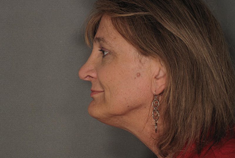 Facial Feminization Before & After Gallery - Patient 120905581 - Image 6
