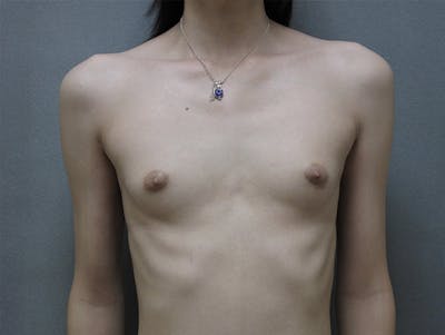 Breast Augmentation Before & After Gallery - Patient 120905583 - Image 1