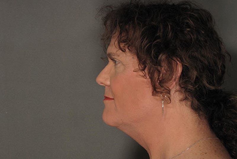 Facial Feminization Before & After Gallery - Patient 120905584 - Image 3