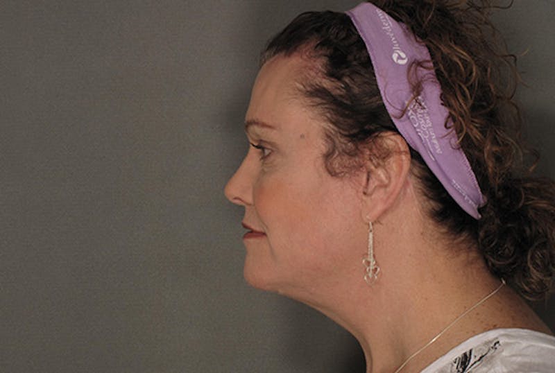 Facial Feminization Before & After Gallery - Patient 120905584 - Image 4
