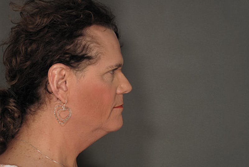 Facial Feminization Before & After Gallery - Patient 120905584 - Image 5