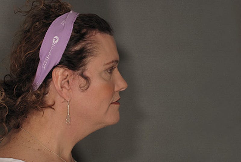 Facial Feminization Before & After Gallery - Patient 120905584 - Image 6