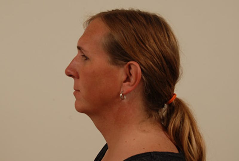 Facial Feminization Before & After Gallery - Patient 120905587 - Image 3