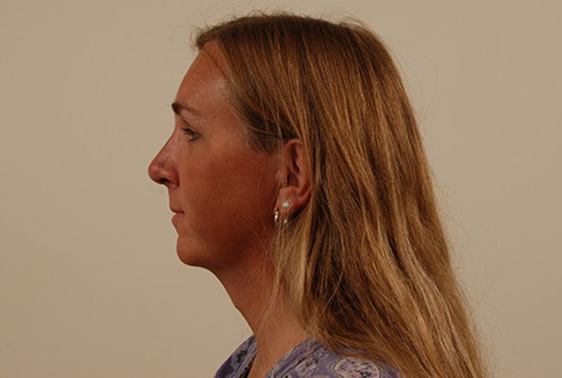 Facial Feminization Before & After Gallery - Patient 120905587 - Image 4