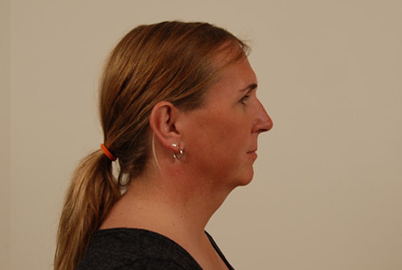 Facial Feminization Before & After Gallery - Patient 120905587 - Image 5