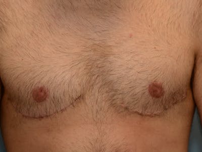 Top Surgery Before & After Gallery - Patient 120905589 - Image 2