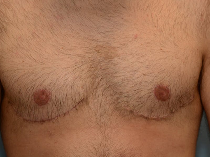 Top Surgery Before & After Gallery - Patient 120905589 - Image 2